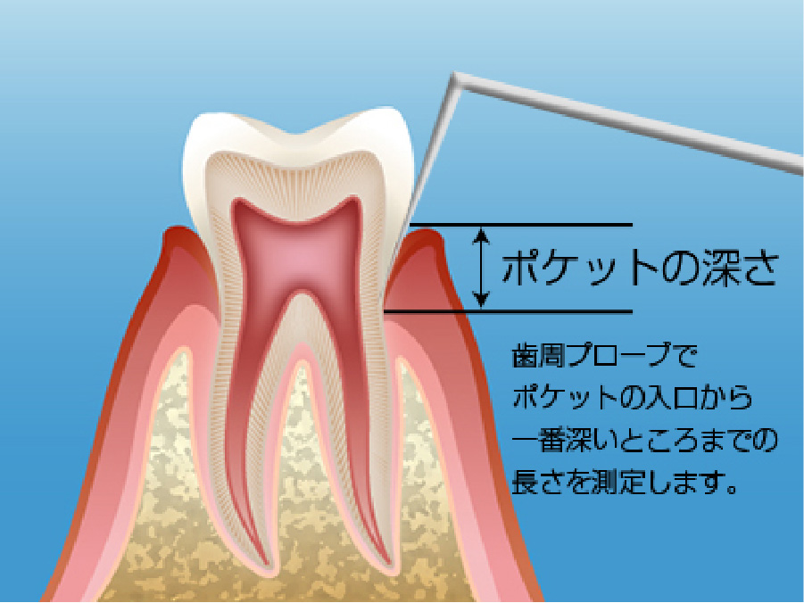 歯周ポケットの深さ