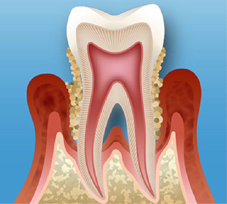 歯周病