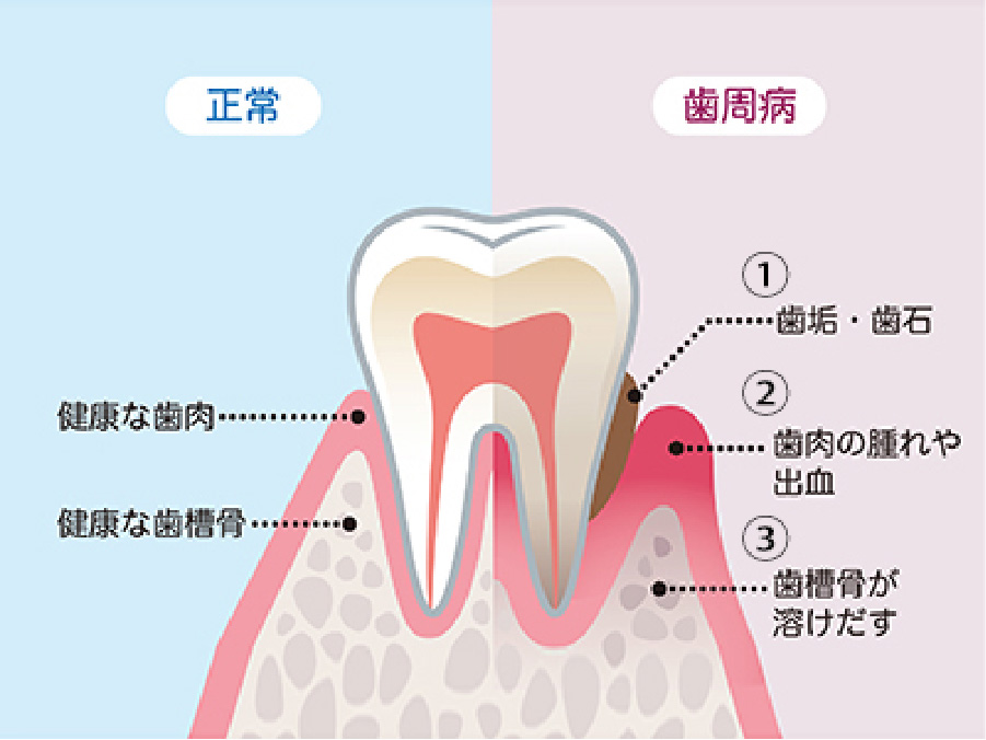 歯周の検査